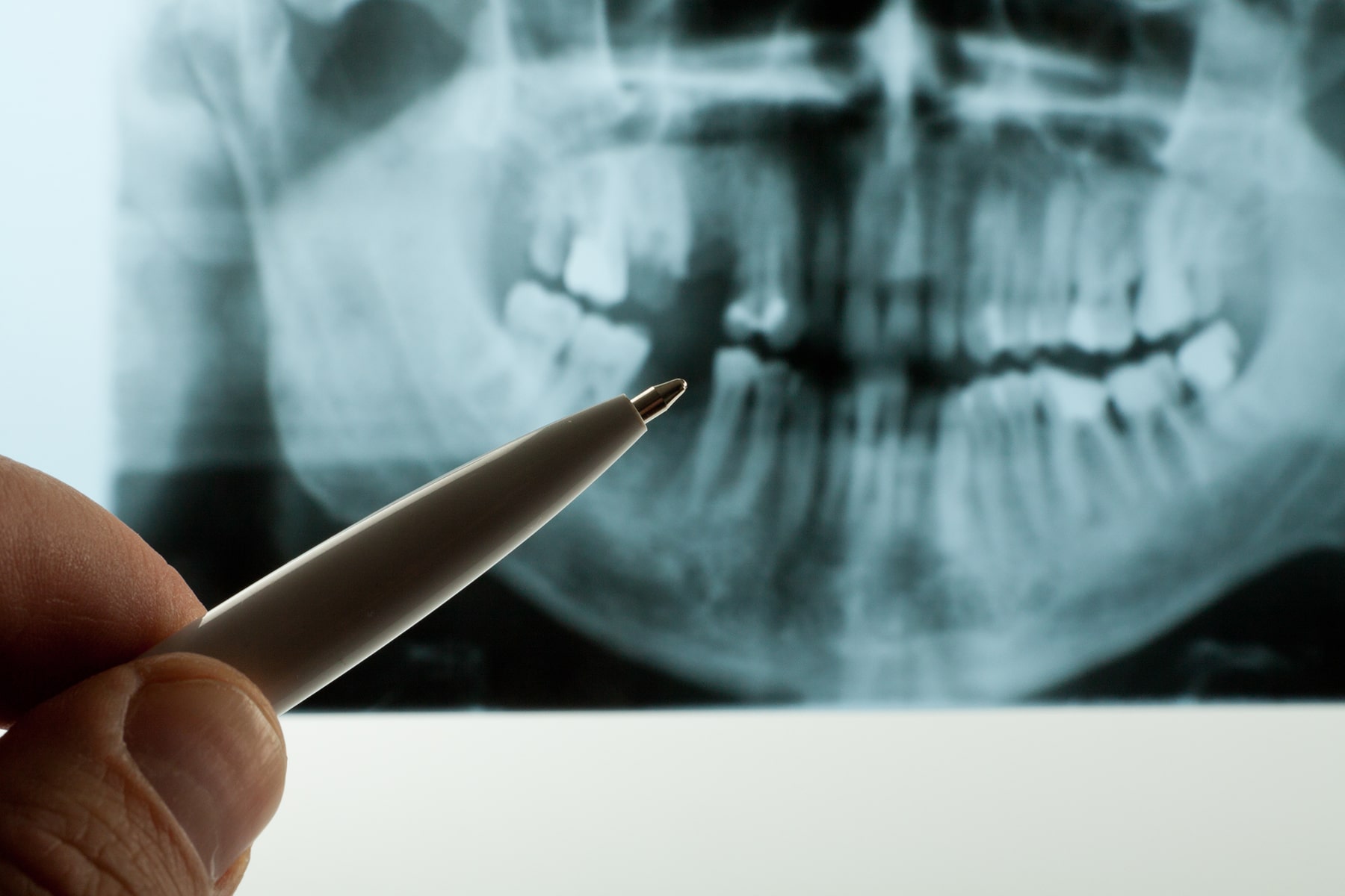 Root canal dentist in Wareham, MA